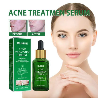 OUHOE Anti-Acne Facial Serum for Oil Control & Pores