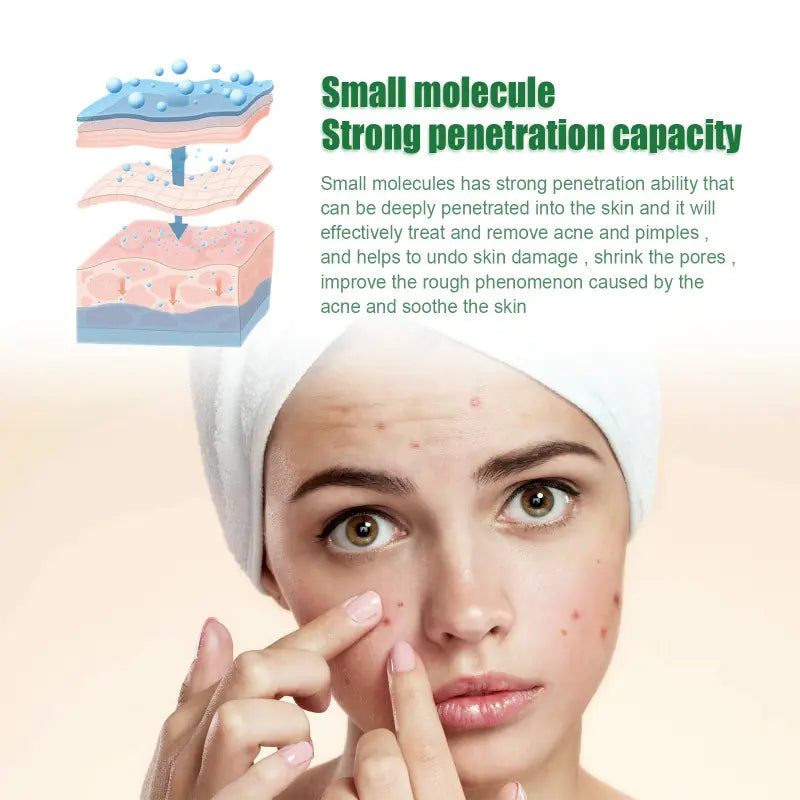 OUHOE Anti-Acne Facial Serum for Oil Control & Pores
