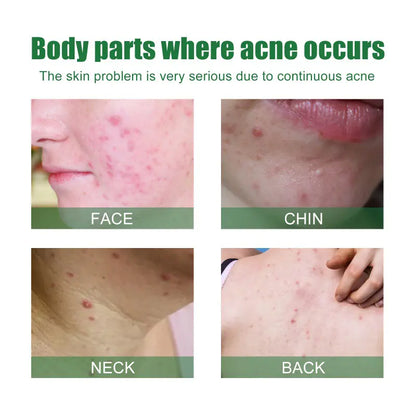 OUHOE Anti-Acne Facial Serum for Oil Control & Pores
